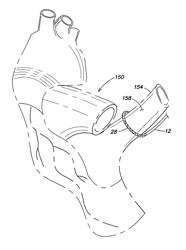 Methods of using a catheter having a braided conductive member