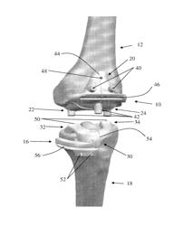 Low profile patient specific cutting blocks for a knee joint