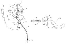 Implantable devices and methods for delivering drugs and other substances to treat sinusitis and other disorders