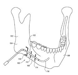 Multi-directional distractor