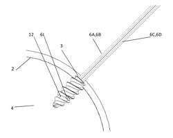 BONE ANCHOR DELIVERY SYSTEM DEVICE WITH SUTURES