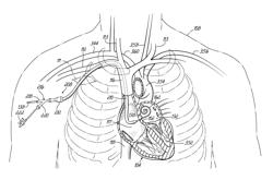 TRANSSEPTAL CANNULA, TIP, DELIVERY SYSTEM, AND METHOD