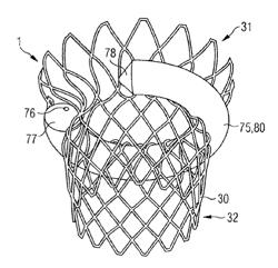 TRANSCATHETER VALVE PROSTHESIS