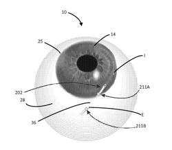 Methods, Systems and Devices for Treating Glaucoma