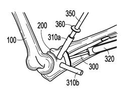 Elbow reconstruction instruments and techniques