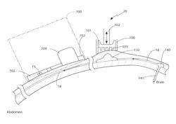 CSF shunt flow enhancer, method for generating CSF flow in shunts and assessment of partial and complete occlusion of CSF shunt systems