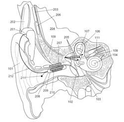 Vestibular implant system with internal and external motion sensors