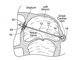 Devices, Systems, and Methods for Reshaping a Heart Valve Annulus, Including the Use of a Bridge Implant Having an Adjustable Bridge Stop