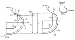 PROSTHESIS AND METHOD FOR USING PROSTHESIS TO FACILITATE DEEP KNEE FLEXION