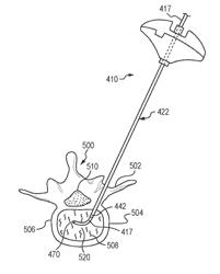 Apparatus and method for stylet-guided vertebral augmentation