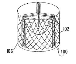 Prosthetic heart valve and method