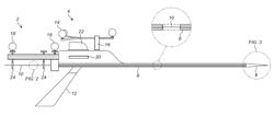 TREATMENT OF HEADACHE BY INJECTION OF NEUROINHIBITORY SUBSTANCE TO SPHENOPALATINE GANGLION OR OTIC GANGLION