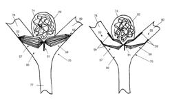 Vascular remodeling device