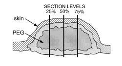 Methods and systems of matching voice deficits with a tunable mucosal implant to restore and enhance individualized human sound and voice production