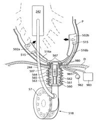 HEART HELP DEVICE, SYSTEM, AND METHOD