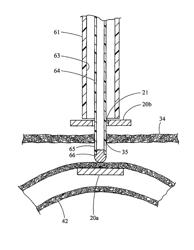 Intestinal bypass using magnets