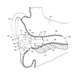 OCCLUSION DEVICE CAPABLE OF OCCLUDING AN EAR CANAL