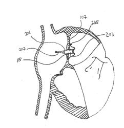 METHODS, SYSTEMS, AND DEVICES FOR RESIZABLE INTRA-ATRIAL SHUNTS