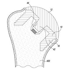 STEMLESS HUMERAL COMPONENT OF AN ORTHOPAEDIC SHOULDER PROSTHESIS