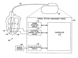 Contractility modulation based on impedance signal