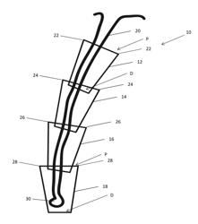 Segmented Suture Anchor