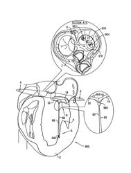 Implantation of repair chords in the heart