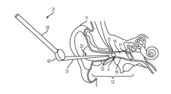 AURAL FOREIGN BODY REMOVAL DEVICE AND RELATED METHODS OF USE AND MANUFACTURE