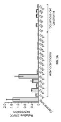 SRPX for treatment of cancer