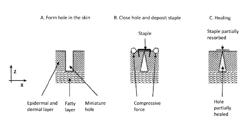 MICROCLOSURES AND RELATED METHODS FOR SKIN TREATMENT