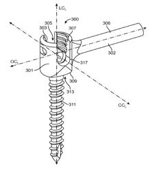 Polyaxial bone screw with lateral connector