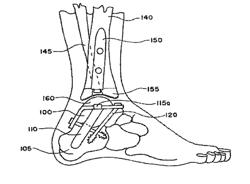 Ankle replacement system