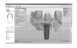 TOOLS FOR CUSTOMIZED DESIGN OF DENTAL RESTORATIONS