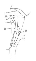 Orthopedic device for treating complications of the hip