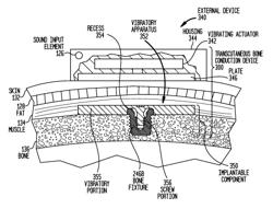 Implantable component of a hearing prosthesis