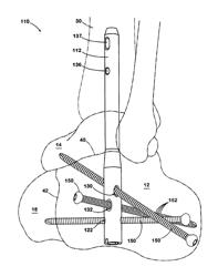 Hindfoot nail