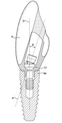 DENTAL IMPLANT SCREW AND INSTALLATION TOOLS WITH OFFSET DRIVE ANGLE