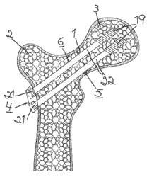 Method for fixation of bone fragments at bone fractures