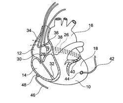 DEVICE FOR ASSESSMENT AND THERAPY OF TEMPORAL VENTRICULAR DESYNCHRONIZATION