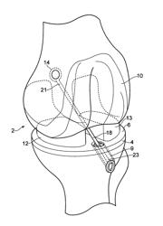 LIGAMENT ASSEMBLY