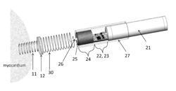 Minimally invasive epicardial pacemaker