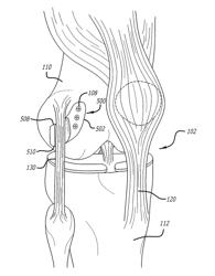 Active and Passive Devices for Redistributing Forces for the Medial and Lateral Knee