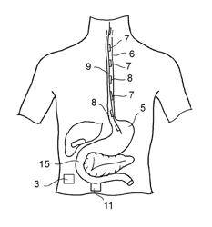 Devices and methods for the treatment of metabolic disorders