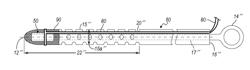 Wireless Pressure Measurement And Monitoring For Shunts