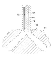 DEVICE, METHOD AND SYSTEM FOR PROVIDING VENTILATORY ASSIST TO A PATIENT