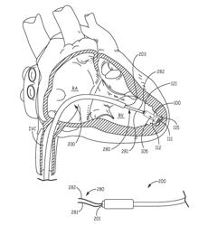 INTERVENTIONAL MEDICAL SYSTEMS AND ASSOCIATED TETHERING ASSEMBLIES AND METHODS