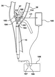 METHODS, DEVICES AND SYSTEMS FOR CAROTID BODY ABLATION VIA A TRANSRADIAL OR TRANSBRACHIAL APPROACH