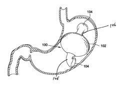 Intragastric Balloon for Treating Obesity