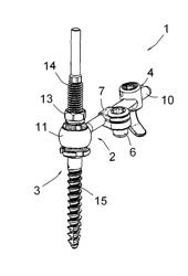 Assembly for treating an isthmic fracture