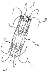 Apical closure system