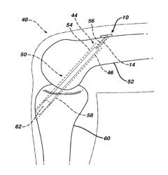 FLIPPING-TYPE GRAFT FIXATION DEVICE AND METHOD